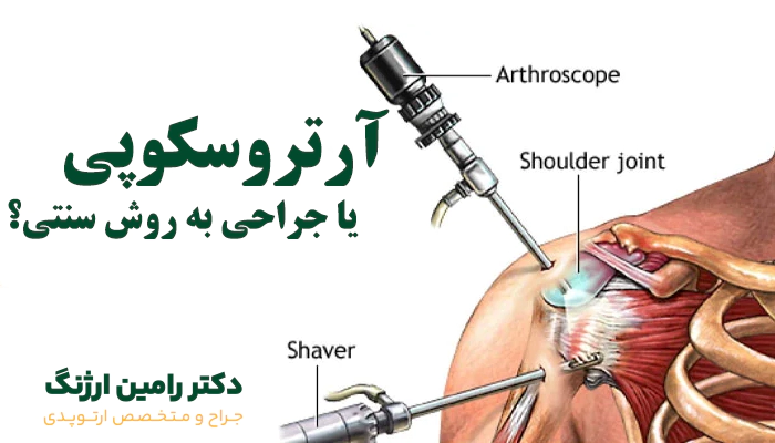آرتروسکوپی بهتر است یا جراحی باز؟