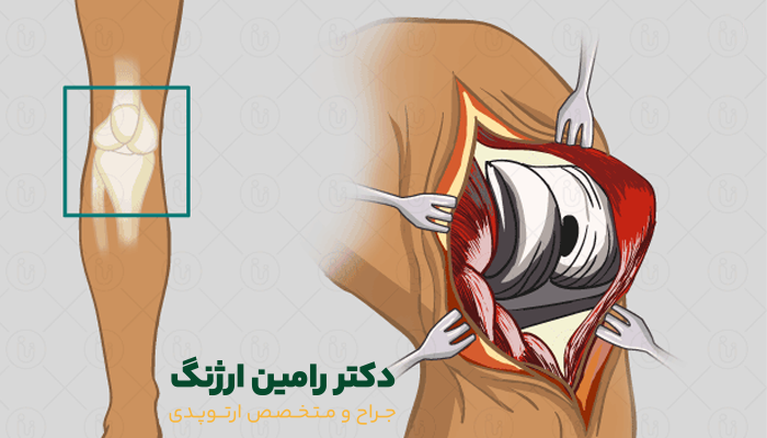 تعویض مفصل زانو