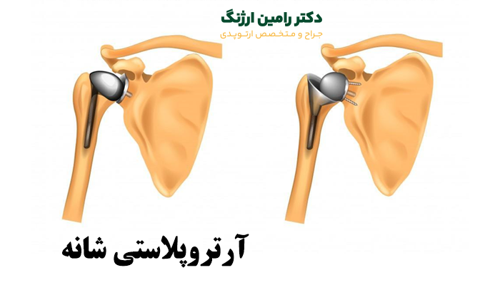 تعویض مفصل شانه