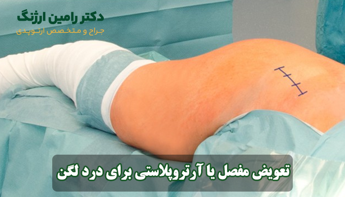 تعویض مفصل یا آرتروپلاستی برای درد لگن