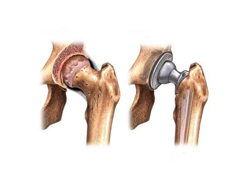 جراحی تعویض مفصل یا آرتروپلاستی چیست