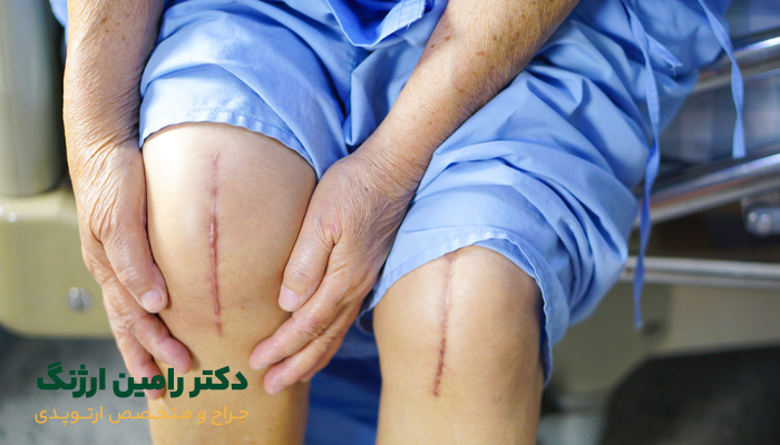 فیزیوتراپی زانو بعد از جراحی