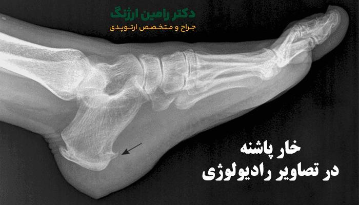 چگونه خار پاشنه تشخیص داده میشود؟