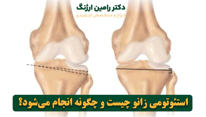 استئوتومی زانو چیست و چگونه انجام میشود؟