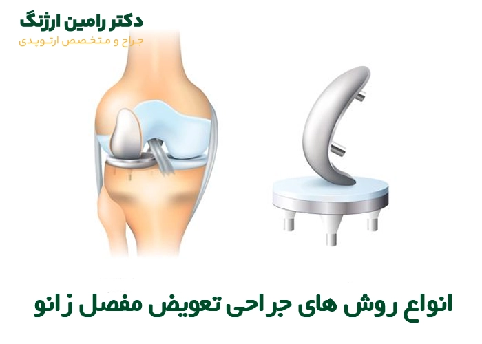 انواع روش های جراحی تعویض مفصل زانو