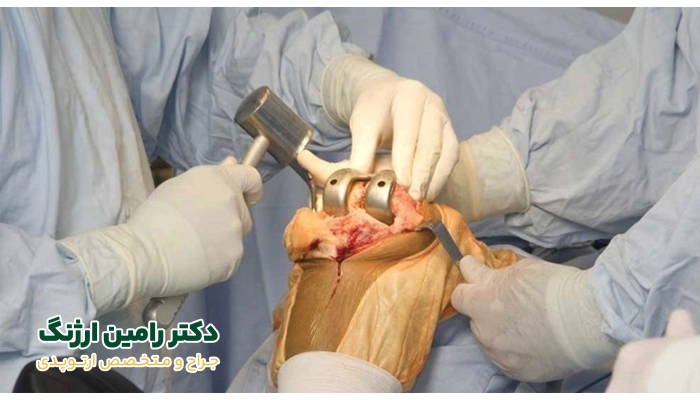 جراح زانوی خوب چه تاثیری در روند جراحی دارد؟