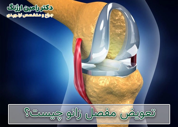 جراحی تعویض مفصل زانو چیست؟