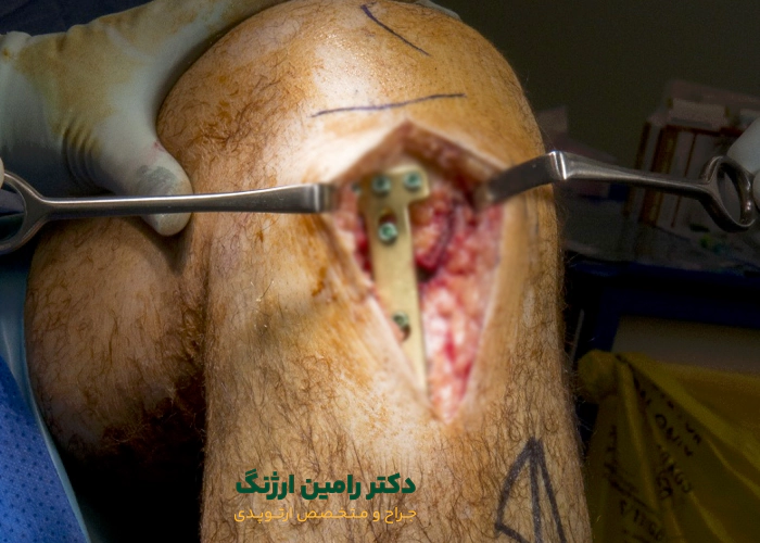 مراحل جراحی استئوتومی زانو