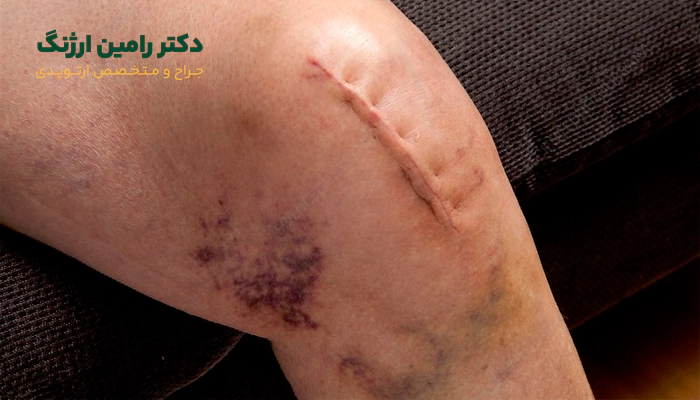 جای زخم تعویض مفصل زانو و مراقبت از آن