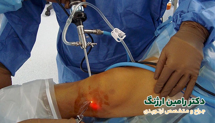مراحل آرتروسکوپی زانو چگونه است؟