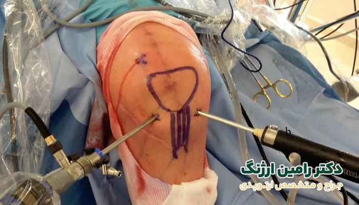 چه زمانی آرتروسکوپی زانو تجویز میشود؟