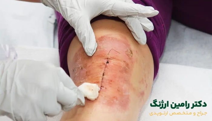 چه زمانی باید به جراح زانو مراجعه کنیم؟